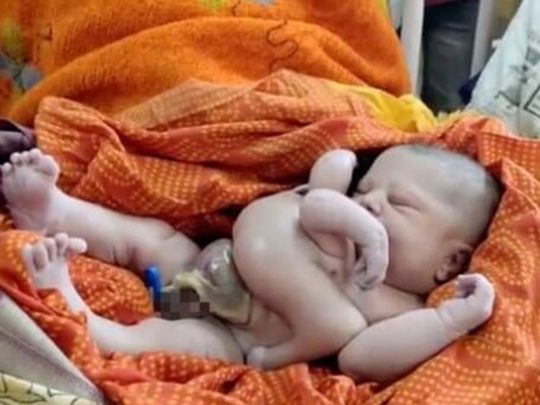 Вважають втіленням бога Вішну: в&nbsp;Індії народилася дитина з&nbsp;чотирма руками та&nbsp;ногами