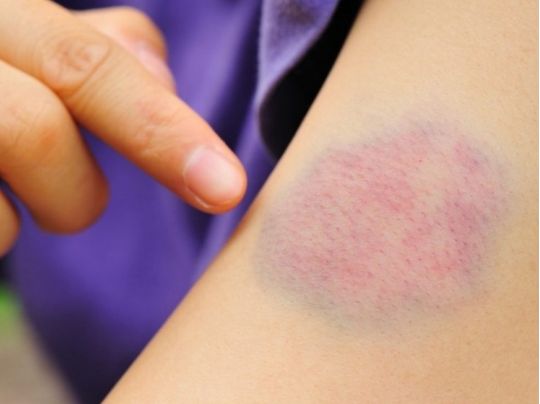 Як швидко позбутися синця: прості та дієві способи