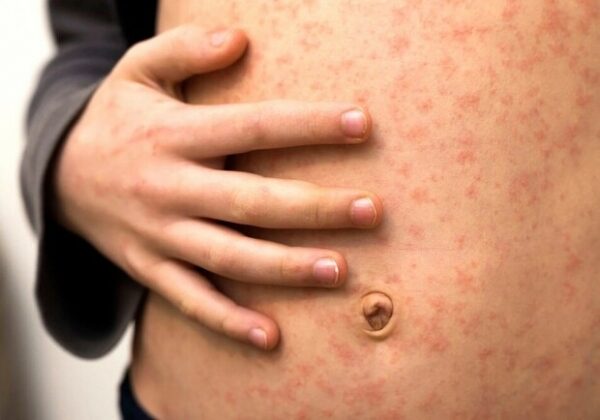 Зафиксировали коклюш и корь: какая эпидситуация в Одесской области Зафиксировали коклюш и корь: какая эпидситуация в Одесской области